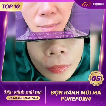 ĐỘN RÃNH MŨI MÁ